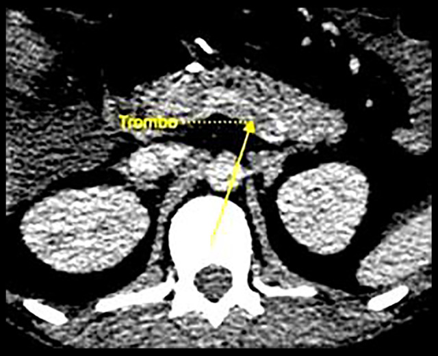 Portomesenteric Vein Thrombosis Following Sleeve Gastrectomy: A Case Report and Literature Review.