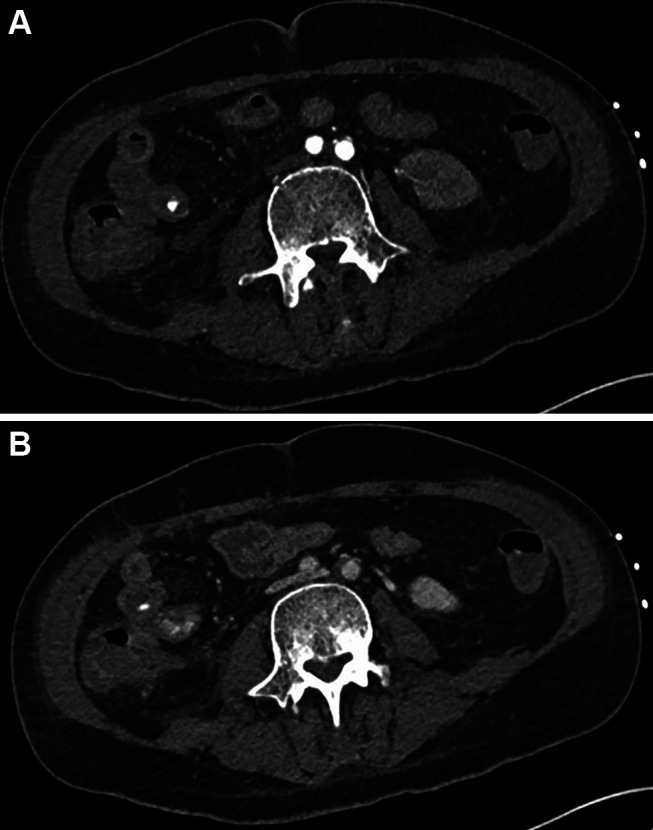 Neutropenic Enterocolitis in Acute Myeloid Leukemia and Morbus Behcet: Pivotal Role of Medical Imaging and Multidisciplinary Management in a Complex Clinical Case.