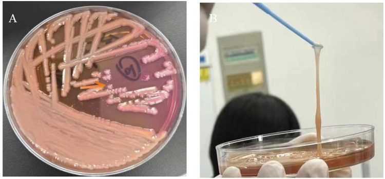 Cerebrospinal Fluid Exchange Combined with Intrathecal Antibiotic Injection for the Management of Severe Intracranial Infection Caused by Hypervirulent <i>Klebsiella pneumoniae</i>: A Case Report.