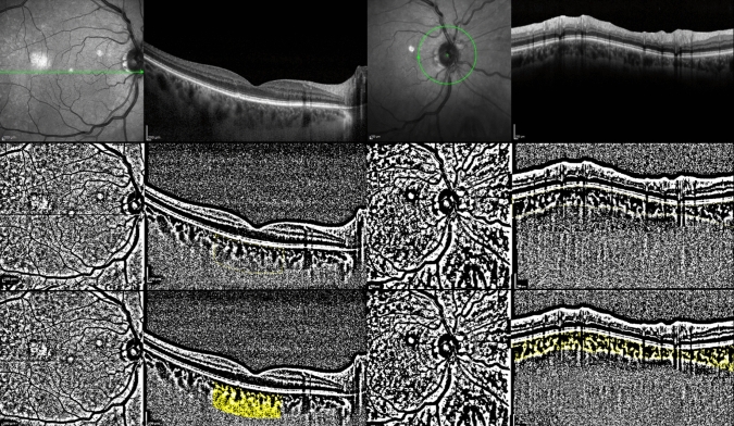 Quantitative evaluation of inflammation after phacoemulsification surgery: anterior chamber flare and choroidal vascular index.
