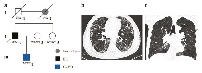 A Rare <i>TERT</i> Mutation Associated with Idiopathic Pulmonary Fibrosis and COPD in a Chinese Family.