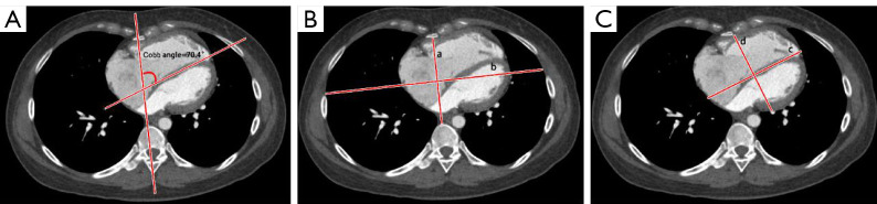 Noninvasive assessment of pulmonary vascular resistance: a synergistic approach using computed tomography pulmonary angiography and echocardiography in pulmonary hypertension.