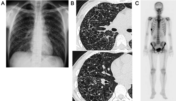 BRAF V600E-Mutant Diffuse Pulmonary Langerhans Cell Histiocytosis Successfully Treated With Dabrafenib Plus Trametinib: A Case Report.