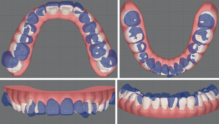 Management of bilateral molar deep overbite with buccal crossbite using bracket-free clear aligners: a case description.