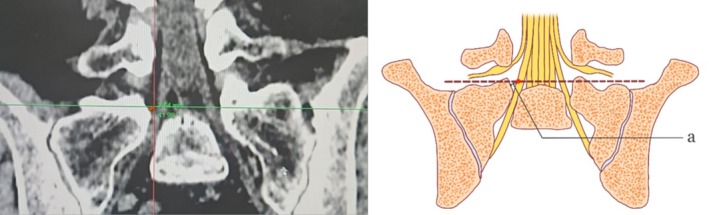 Radiographic Anatomy and Clinical Value of the Modified Corner Approach in Interlaminar Endoscopic Lumbar Discectomy.
