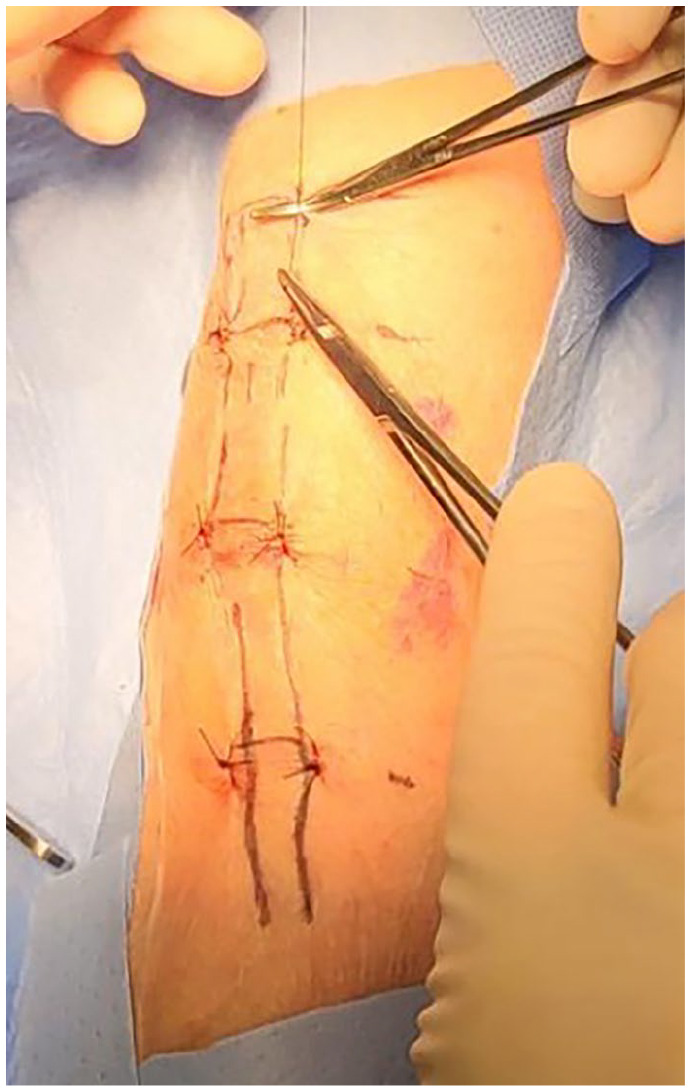 Transcutaneous parallel suture plication to fixate a difficult-to-cannulate brachiobasilic fistula: A case presentation.
