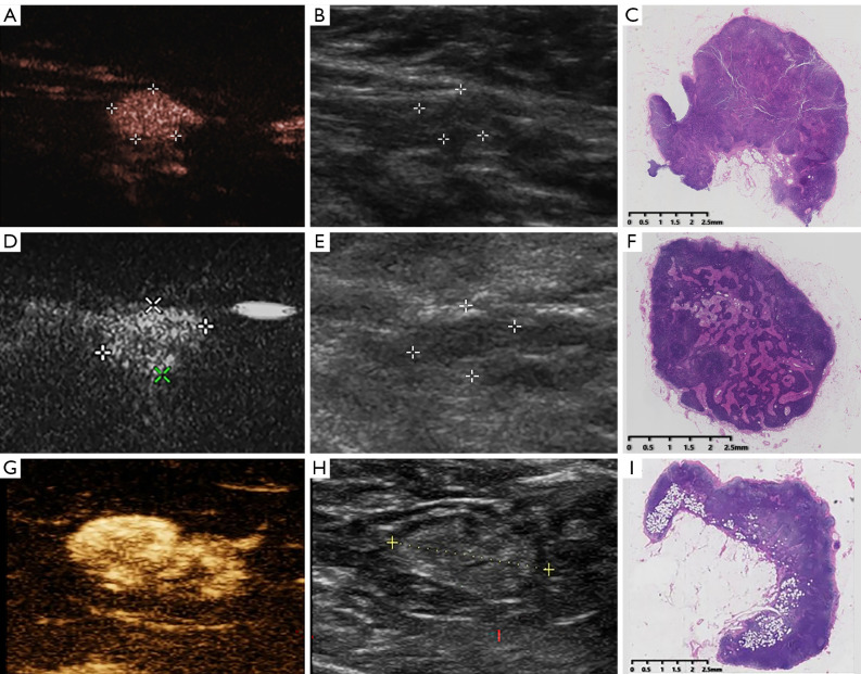 The value of percutaneous contrast-enhanced ultrasound in the detection and diagnosis of sentinel lymph nodes in breast cancer: comparison with pathological features.