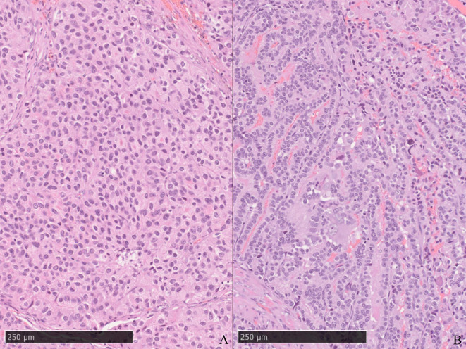 Primary seminal vesicle adenocarcinoma in a squirrel monkey (Saimiri sciureus).