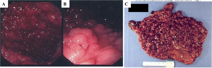 A novel insertion/deletion in APC promotor 1B is associated with both gastric and colon polyposis.