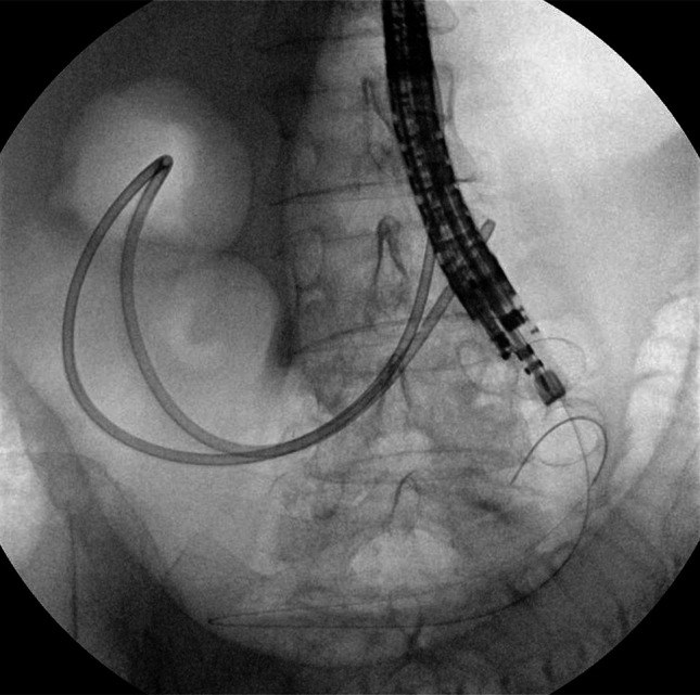 Double Endoscopic Bypass: A Durable Solution to Pair With Improving Systemic Therapy for Metastatic Cancer.