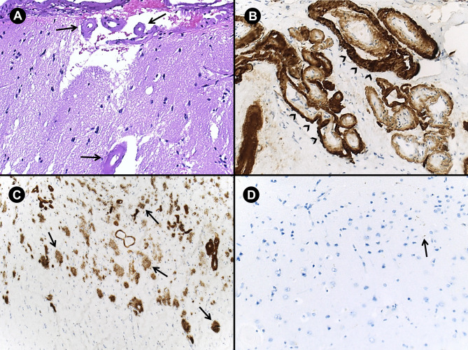 Iatrogenic cerebral amyloid angiopathy: two new cases and systematic review of case reports with neuropathological data.