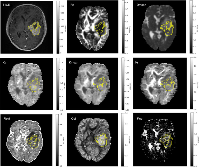 Added prognostic value of histogram features from preoperative multi-modal diffusion MRI in predicting Ki-67 proliferation for adult-type diffuse gliomas.