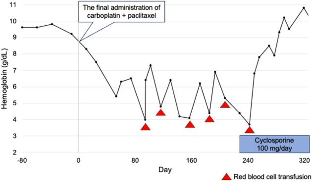 Pure Red Cell Aplasia That Developed 13 Years After Thymoma Treatment: A Case Report and Literature Review.