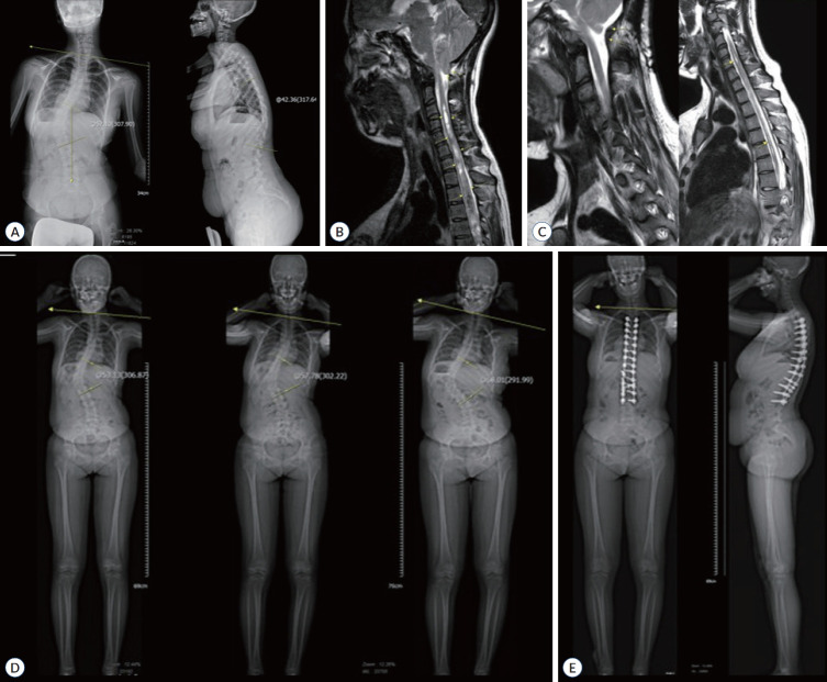 Surgical Correction for Adolescent Idiopathic Scoliosis : A Case Series of 139 Consecutive Patients Treated in Neurosurgical Department.