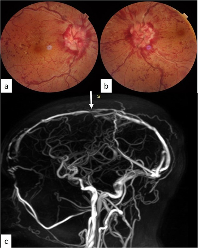 Acute bilateral vision loss secondary to cerebral venous thrombosis-induced intracranial hypertension: a case report.