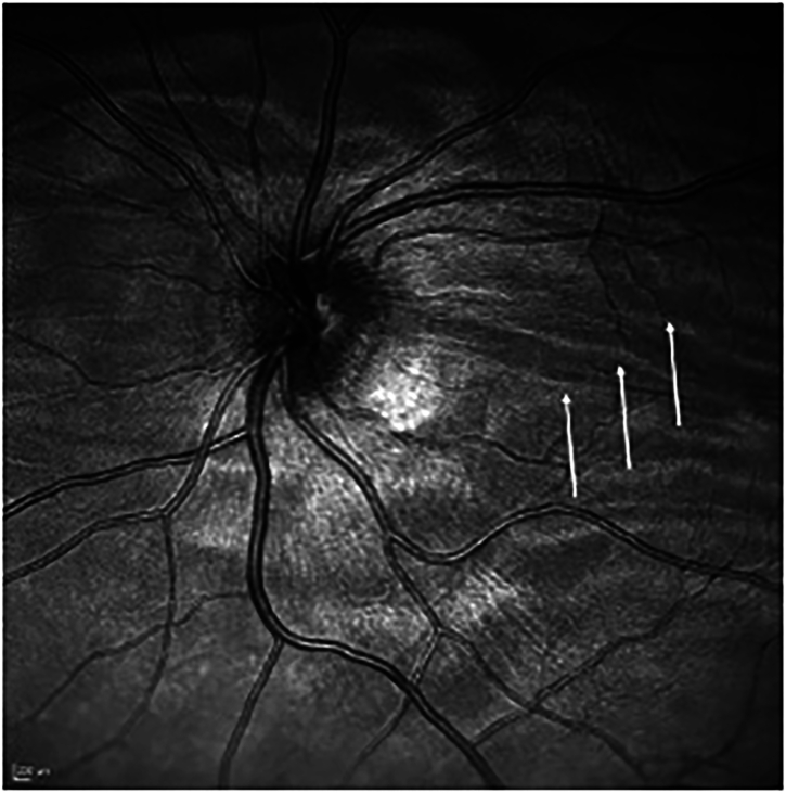 Non invasive monitoring for spaceflight associated neuro ocular syndrome: responding to a need for In flight methodologies.