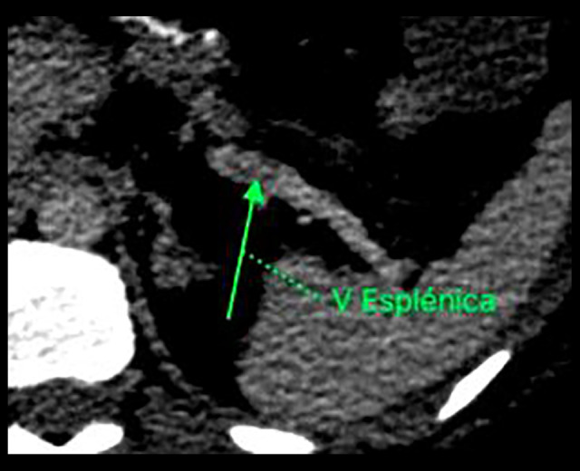 Portomesenteric Vein Thrombosis Following Sleeve Gastrectomy: A Case Report and Literature Review.