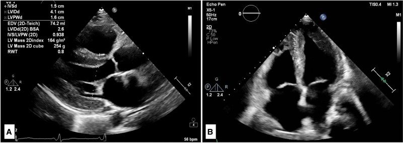 Long-term hydroxychloroquine use resulting in cardiomyopathy and conduction abnormalities: a case report.