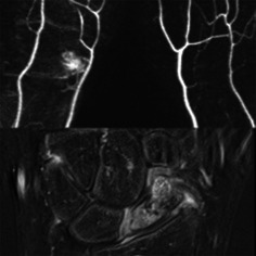 The Analysis of Magnetic Resonance Imaging on the Intra- and Extra-Osseous Blood Supply After Scaphoid Fractures.