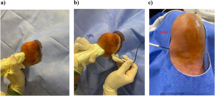 Comparative Effectiveness of Ultrasound-Guided Corticosteroid Injection, Radiofrequency Ablation, and Their Combination for Recalcitrant Plantar Fasciitis: A Retrospective Cohort Study.
