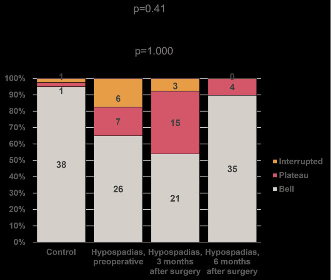Insight into the early postoperative improvement of the functionality of the reconstructed urethra after distal hypospadias repair treated by the Snodgrass technique.