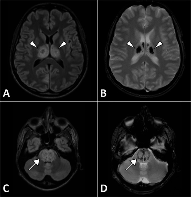 Acute necrotizing encephalopathy in a young adult triggered by adenovirus: a rare etiology of a devastating neurological syndrome.