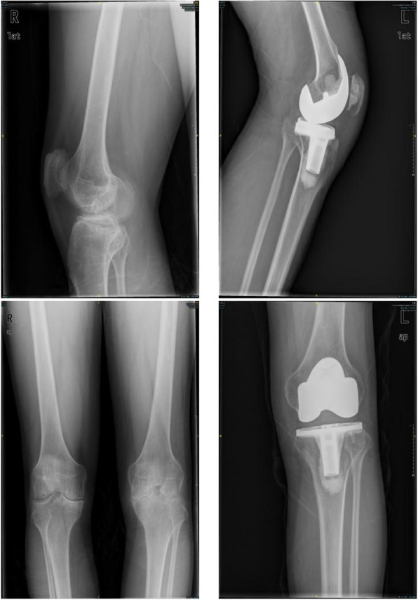 Total knee arthroplasty for ankylosed knees in the extended position with hemophilia: a medium- and long-term single-center experience.