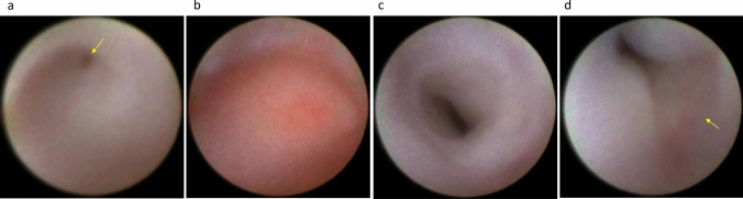 Dacryoendoscopy as a frontier technology for lacrimal drainage disorders.