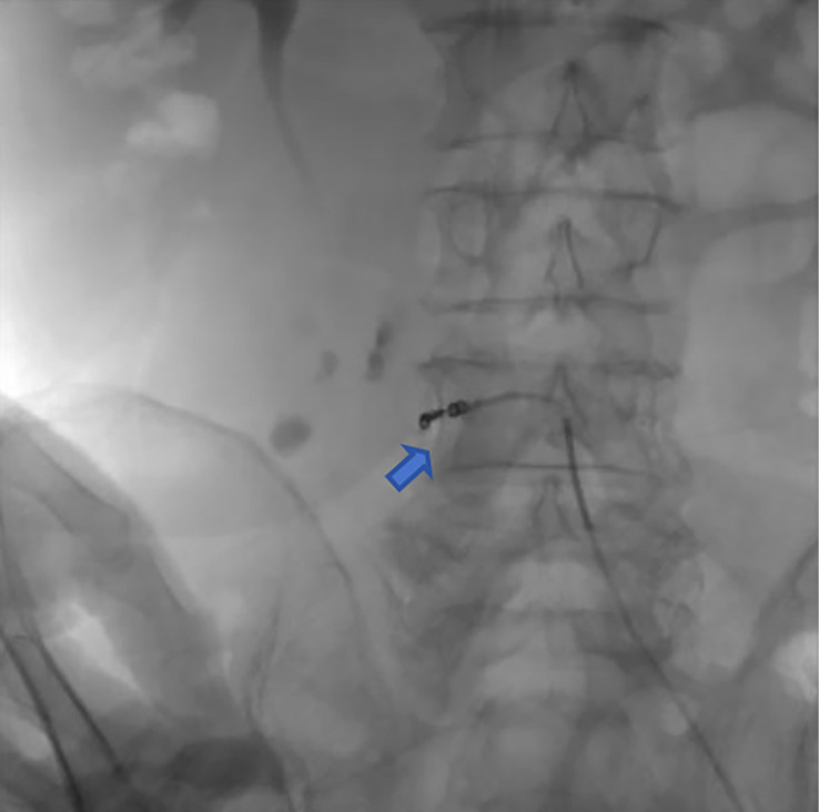 Transcatheter arterial embolization for retroperitoneal bleeding in patients with lumbar artery injury and essential thrombocythemia: a case description.