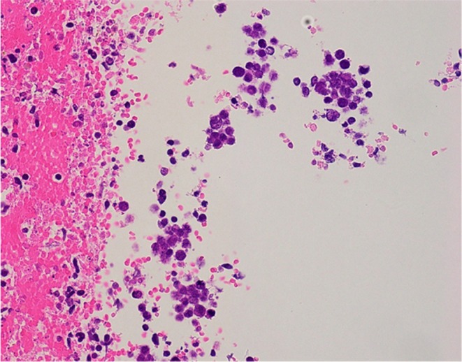 Successful Early Treatment of Anti-N-Methyl-d-Aspartate Receptor Encephalitis Associated With Small Cell Lung Cancer in an Elderly Male Patient: A Case Report.