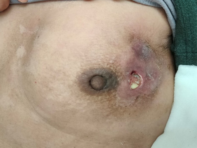 A case report of breast abscess caused by Peptoniphilus harei after endoscopic breast-conserving surgery and radiotherapy for breast cancer and literature review.
