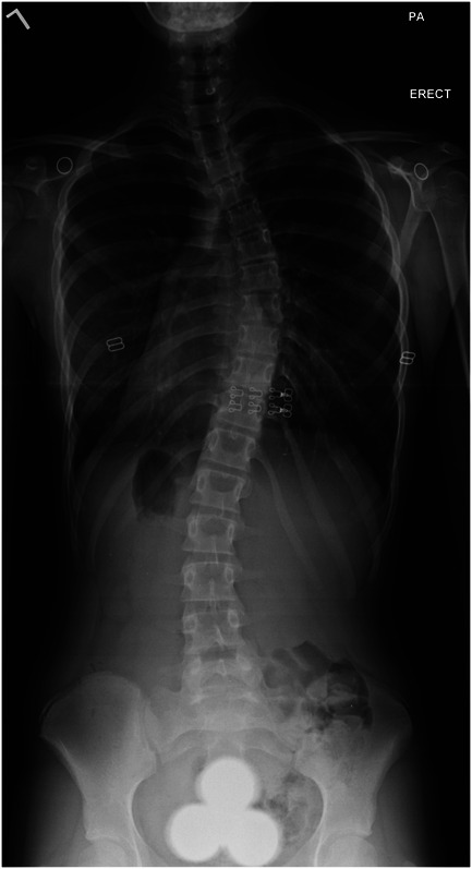 Results of a Retrospective FDA Investigational Device Exemption Study for Anterior Vertebral Body Tethering in Adolescent Idiopathic Scoliosis with 3-Year to 10-Year Follow-Up.