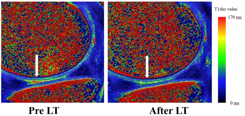 Evaluation of Cartilage Degeneration Using MRI T1ρ Mapping after Locomotion Training in Patients with Early Knee Osteoarthritis.