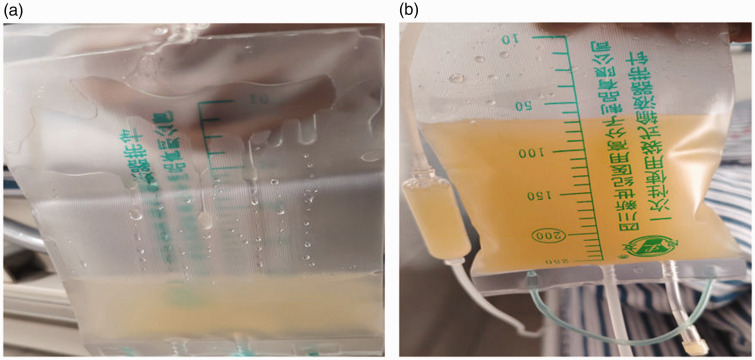 Management of chylous pleural and peritoneal effusions in a cirrhotic patient: A case report and review of literature.