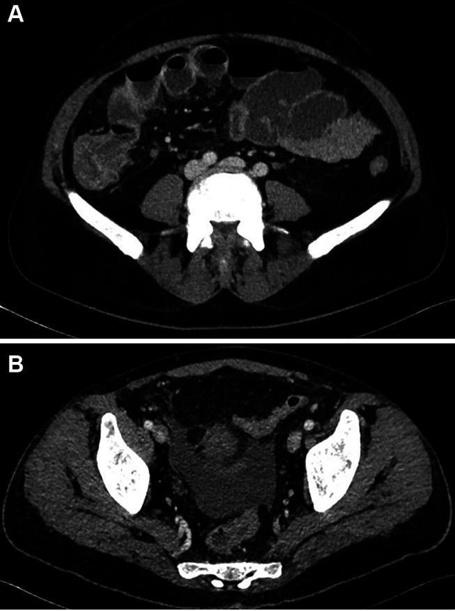 Neutropenic Enterocolitis in Acute Myeloid Leukemia and Morbus Behcet: Pivotal Role of Medical Imaging and Multidisciplinary Management in a Complex Clinical Case.