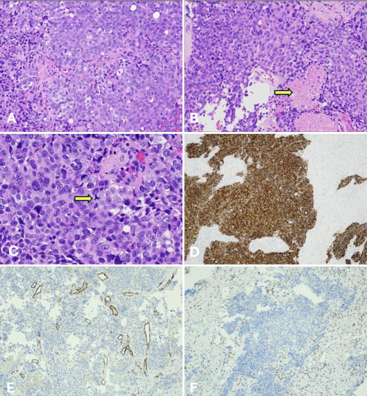 Brain tumors linked to Chernobyl radiation exposure: a case study and historical perspective. Illustrative cases.