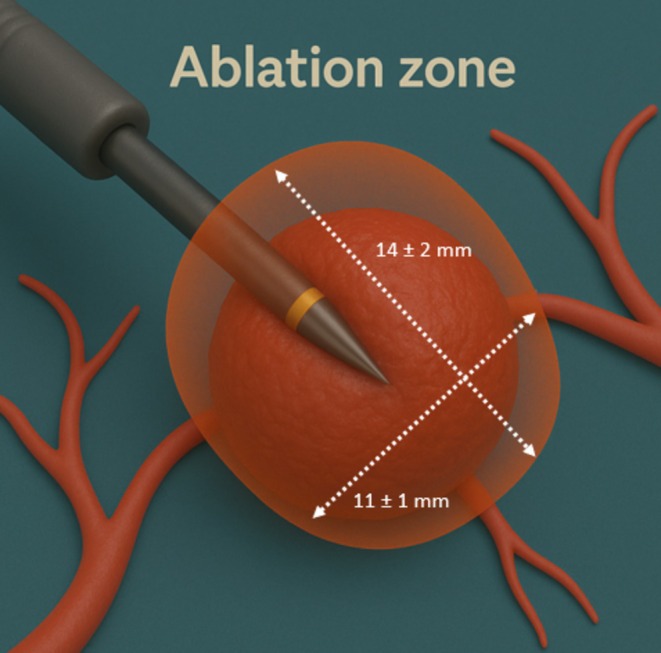 AIM (Anticipate/Adjust, Image, Manage) to Prevent Bleeding During Robotically-Assisted Bronchoscopic Ablation.