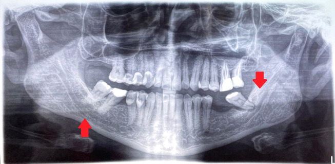 The Real Anatomy of Mandibular Canal: "New Features and Prospectives in Oral and Maxillofacial Surgery".
