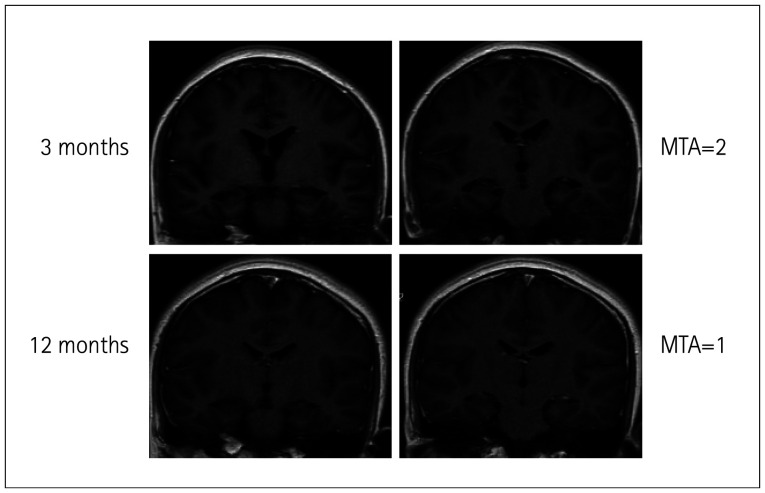 Brain Atrophy Can Predict the Severity and Prognosis of Anti-N-Methyl-D-Aspartate Receptor Encephalitis.