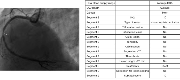 A scoring system combining CatLet score and clinical variables as a predictor of long-term prognosis in patients with chronic coronary syndrome after percutaneous coronary intervention.