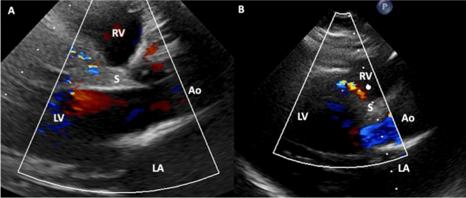A 39-year-old women with newly diagnosed ALCAPA syndrome during pregnancy.