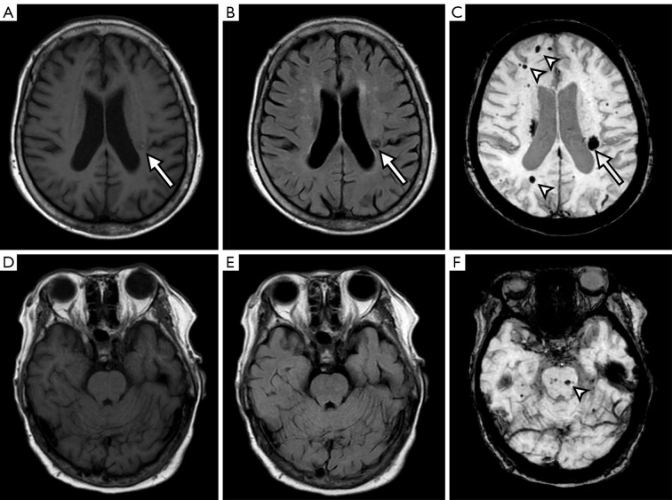 Late-onset familial cerebral cavernous malformation without a family history: a case description.