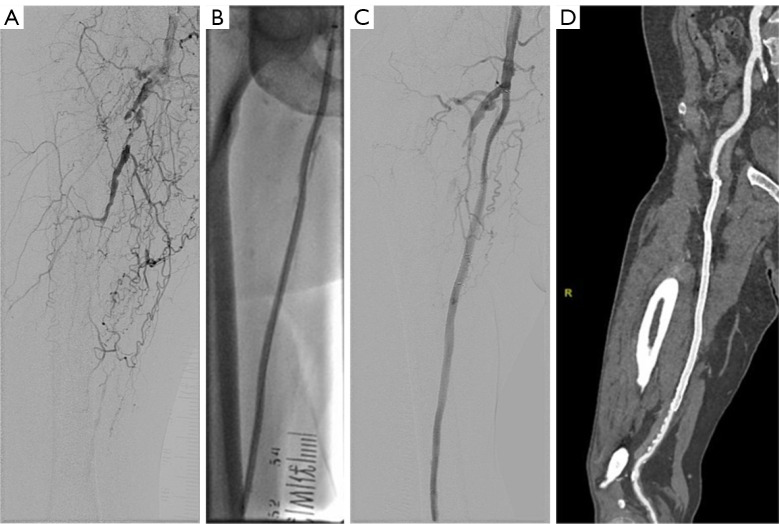 Drug-coated balloon with bailout stenting versus drug-eluting stent plus drug-coated balloon in TransAtlantic Inter-Society Consensus C and D femoropopliteal lesions: a propensity score-matched analysis.