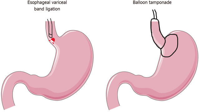 Decline of the Sengstaken-Blakemore tube: A review of shifting practices in gastrointestinal hemorrhage management.