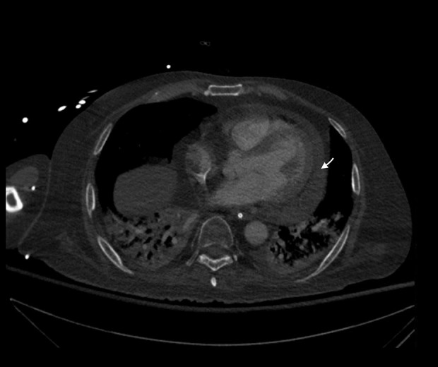Severe Disseminated Adenovirus Infection After Haploidentical Hematopoietic Stem Cell Transplantation: A Case Report.