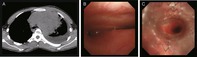 Hybrid Tracheal Stent Ingestion in Malignant Central Airway Stenosis: A Case Report.