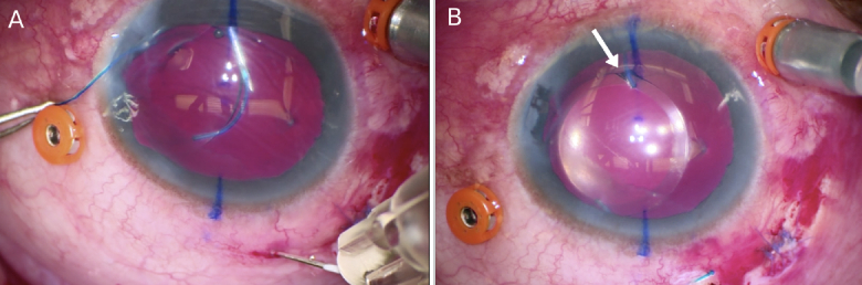 Haptic-Optic Fractures in Yamane Flanged Intrascleral Fixated Lenses: A Case Series.
