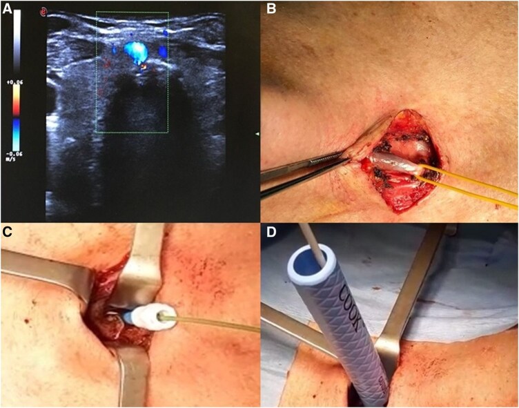 Ultrasound and Three-Dimensional Image Reconstruction Angio-Computed Tomography Scan for Hybrid Surgical Tracheostomy in Patient with Abnormal Neck Vascularization.