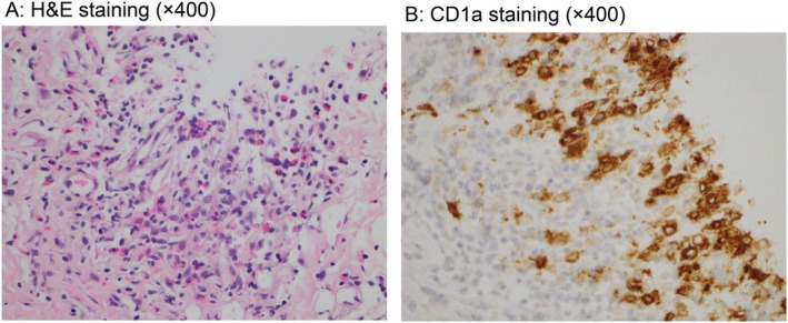 BRAF V600E-Mutant Diffuse Pulmonary Langerhans Cell Histiocytosis Successfully Treated With Dabrafenib Plus Trametinib: A Case Report.