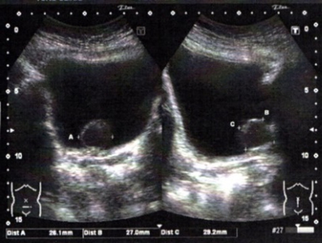 Bladder Leiomyoma Presenting with Recurrent Cystitis: A Case Report.